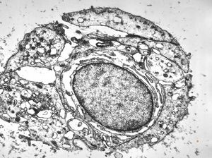 F, 62y. | myxoma atrii